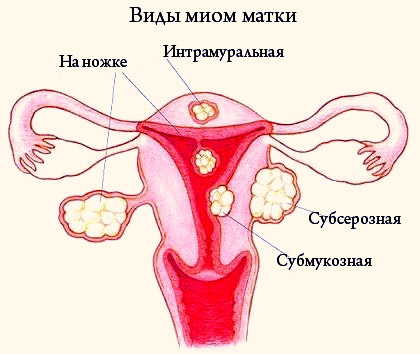 Лечение миомы матки в отделении современной гинекологии Медицинского центра Гриценко